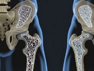 cura-riabilitazione-osteoporosi_800x446
