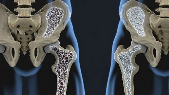 cura-riabilitazione-osteoporosi_800x446